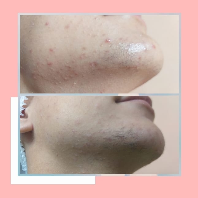 Evolução do tratamento de acne - Foto 2